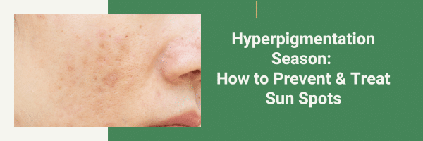 Hyperpigmentation Season: How to Prevent & Treat Sun Spots