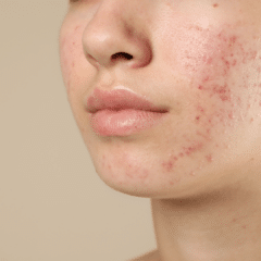 acne
